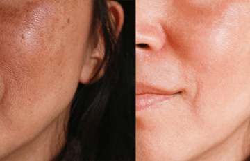 Before and after comparison showing skin improvement with Iconique Collagène, highlighting texture and radiance.