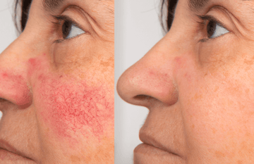 Before and after treatment showcasing skin improvement with Iconique Collagène, highlighting reduction in redness and wrinkles.
