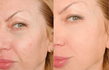 Before and after image showcasing the skin improvement using Iconique Collagène for clearer and smoother complexion.