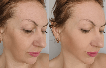 Before and after comparison showing skin improvement with Iconique Collagène treatment, showcasing enhanced texture and tone.