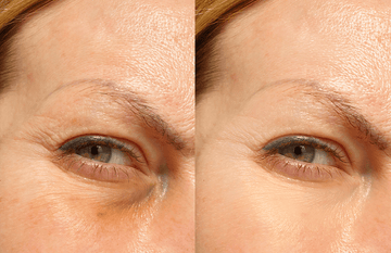 Before and after results showcasing Iconique Collagène effects on eye area, highlighting skin improvement and reduced wrinkles.