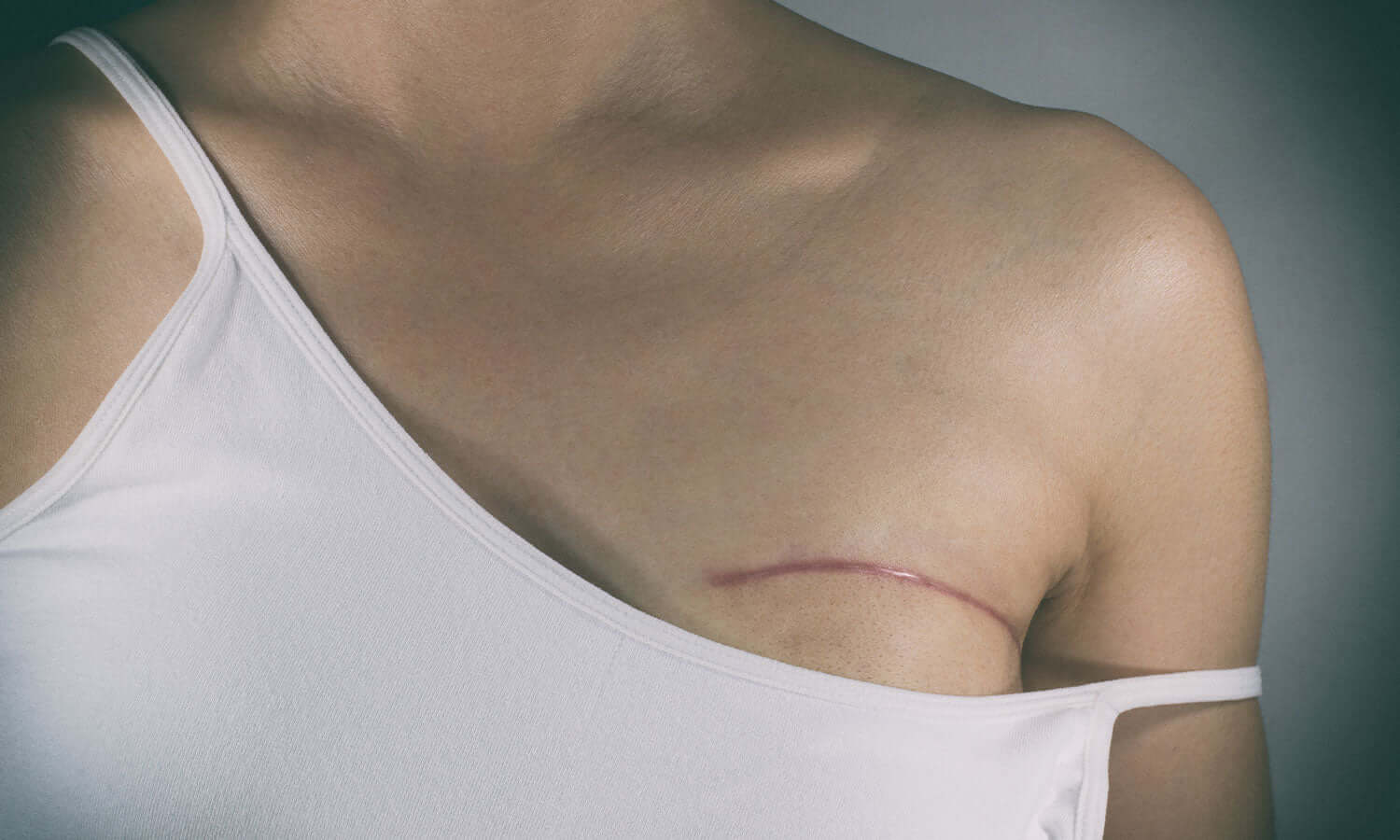 Depuis des décennies, l’hormonothérapie substitutive (HTS) a été prescrite pour soulager les symptômes de la ménopause. Toutefois, des données solides indiquent que les femmes qui ont recours à l’HTS courent un risque accru de cancer du sein